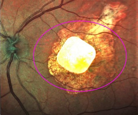 Implanted chip, natural eyesight coordinate vision in study of 